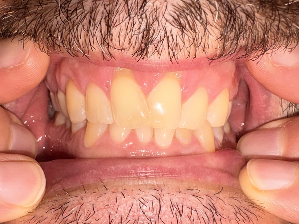 Fotografía intraoral antes del tratamiento